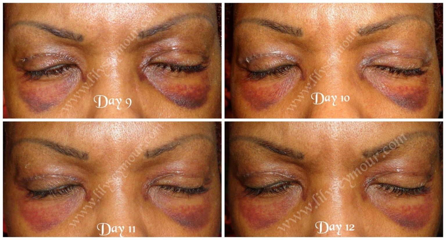 Just What Exactly Is 'The Black Eye Club,' And Why Are So Many